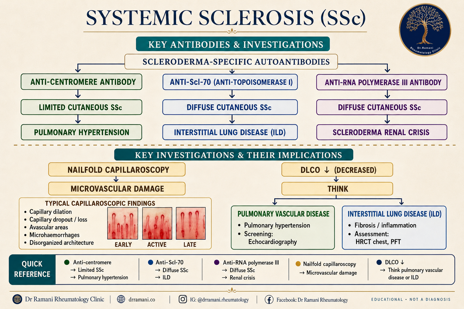Infographic on systemic sclerosis: anti-centromere antibody with limited cutaneous disease and pulmonary hypertension, anti-Scl-70 with diffuse disease and interstitial lung disease, anti-RNA polymerase III with diffuse disease and scleroderma renal crisis, plus nailfold capillaroscopy findings and reduced DLCO pointing to pulmonary vascular disease or lung fibrosis