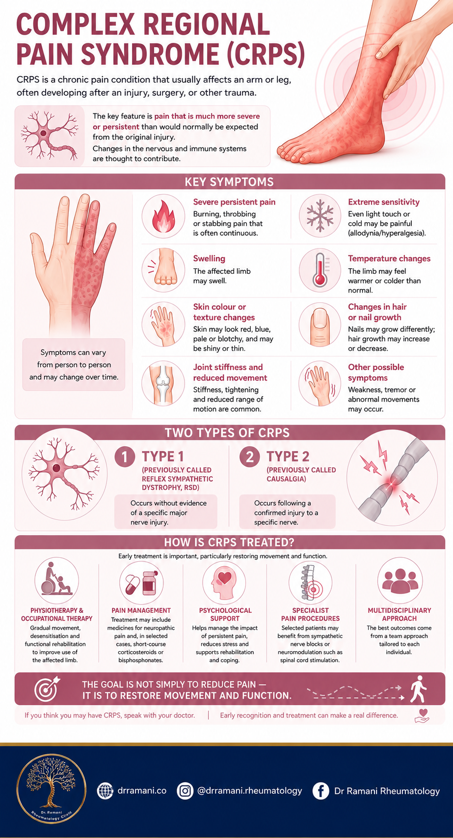 Infographic on complex regional pain syndrome: key symptoms, type 1 and type 2 CRPS, and treatment approaches including physiotherapy, pain management, psychological support and specialist pain procedures
