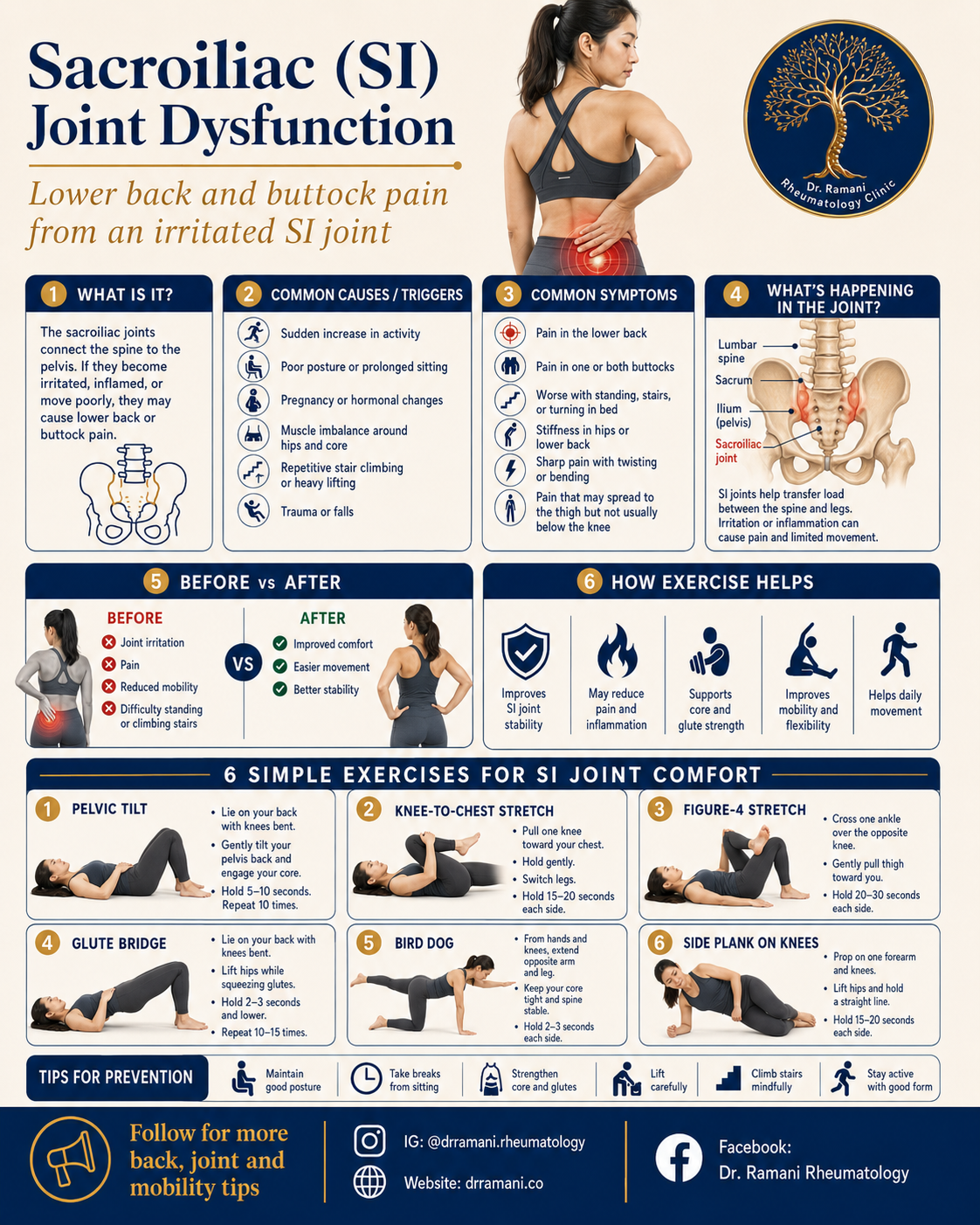 Illustrated patient guide showing sacroiliac joint anatomy, common symptoms and six simple exercises for SI joint comfort.